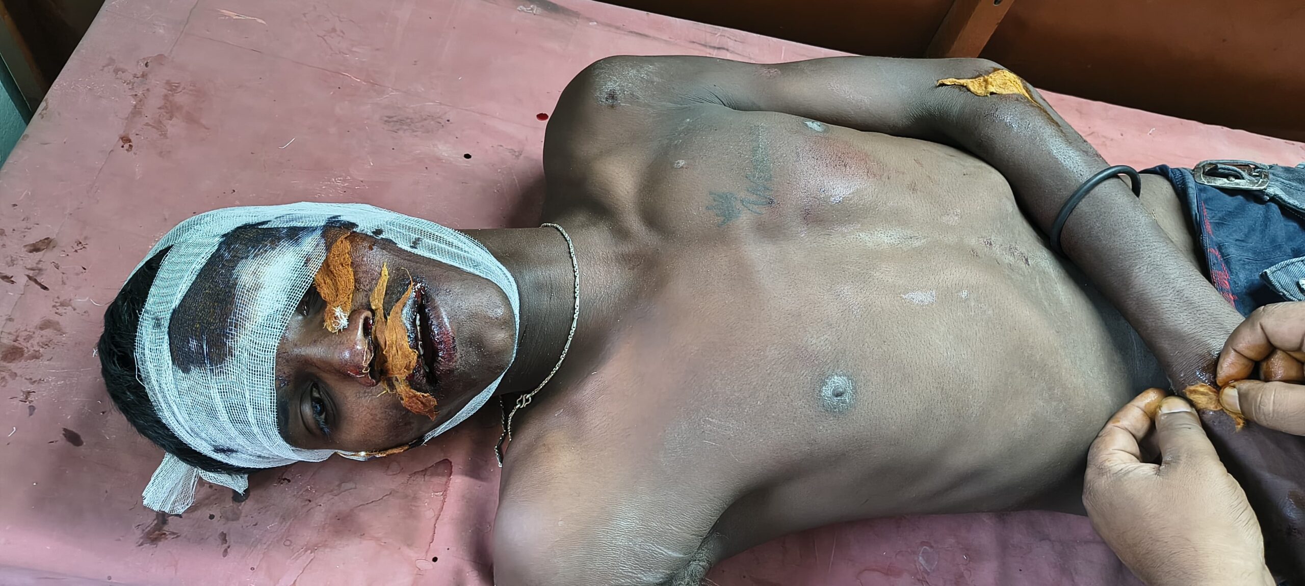 बाईक से गिरकर दो युवक घायल,हॉस्पिटल में कराया गया भर्ती।