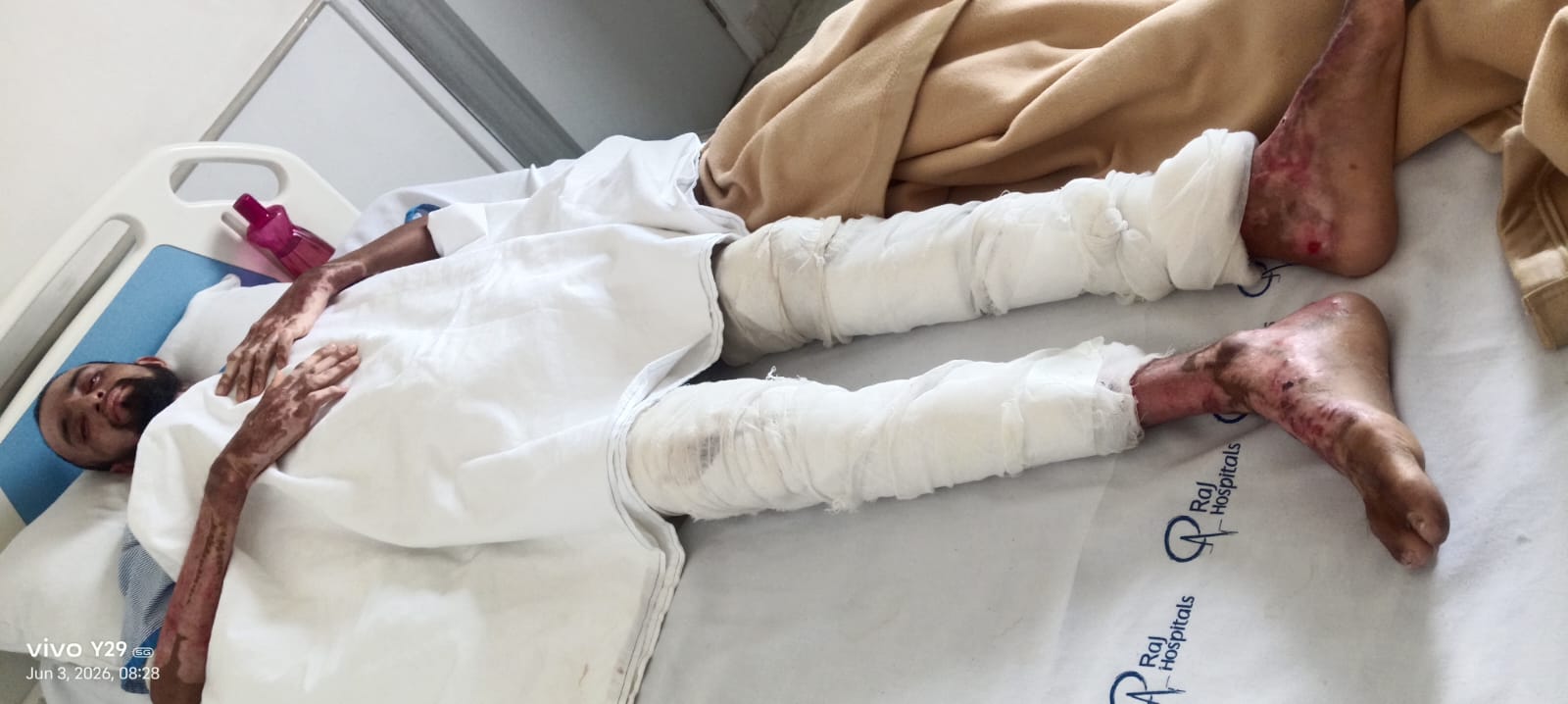 ड्यूटी के दौरान घायल कर्मी अनुज यादव की हालत बिगड़ी,यूनियन ने प्रबंधन पर लगाया उपेक्षा का आरोप।